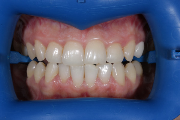 зубы до отбеливания зубы до отбеливания